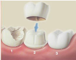 Woodridge dentist dental crowns
