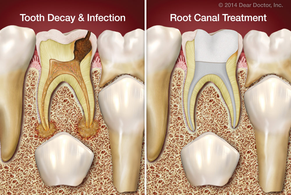 tooth that needs root canal